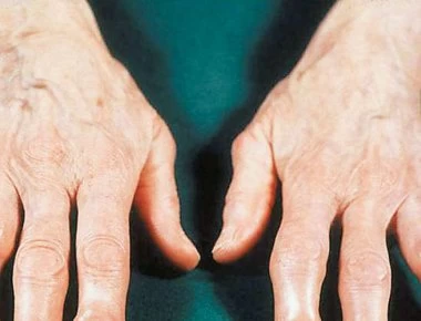 Αρθρίτιδα: Τι ρόλο παίζει η κληρονομικότητα στην ανάπτυξή της